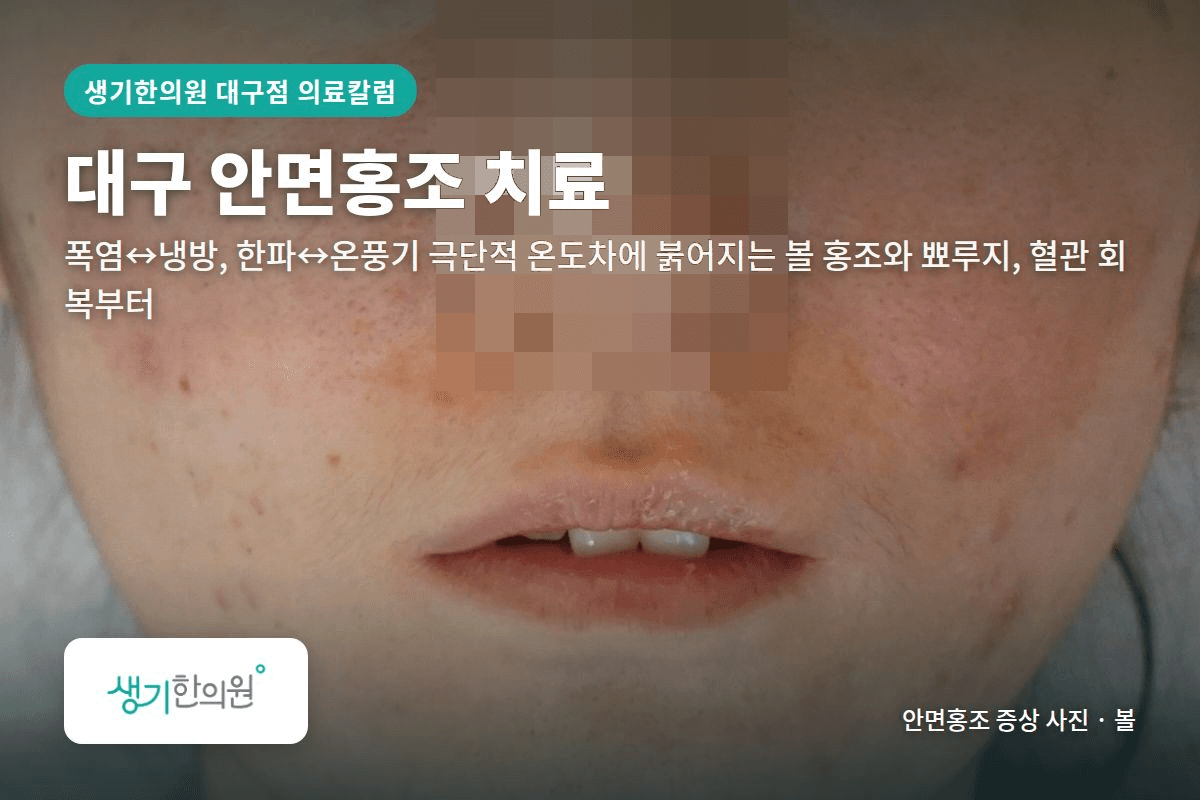 볼 안면홍조 증상 사진과 문구 「대구 안면홍조 치료, 폭염↔냉방, 한파↔온풍기 극단적 온도차에 붉어지는 볼 홍조와 뾰루지, 혈관 회복부터 · 생기한의원 대구점」