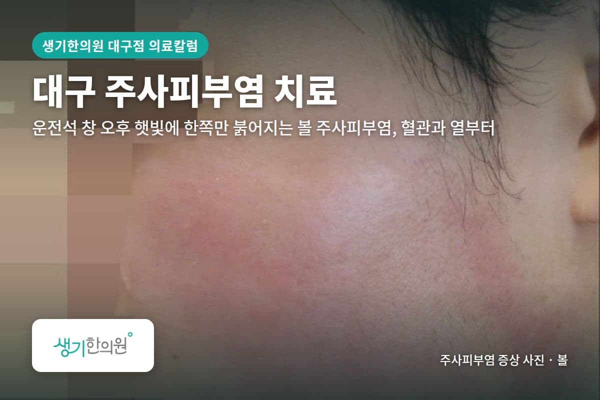 볼 주사피부염 증상 사진과 문구 「대구 주사피부염 치료, 운전석 창 오후 햇빛에 한쪽만 붉어지는 볼 주사피부염, 혈관과 열부터 · 생기한의원 대구점」