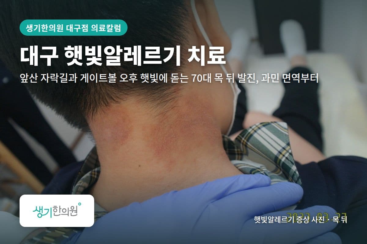 목 뒤 햇빛알레르기 증상 사진과 문구 「대구 햇빛알레르기 치료, 앞산 자락길과 게이트볼 오후 햇빛에 돋는 70대 목 뒤 발진, 과민 면역부터 · 생기한의원 대구점」