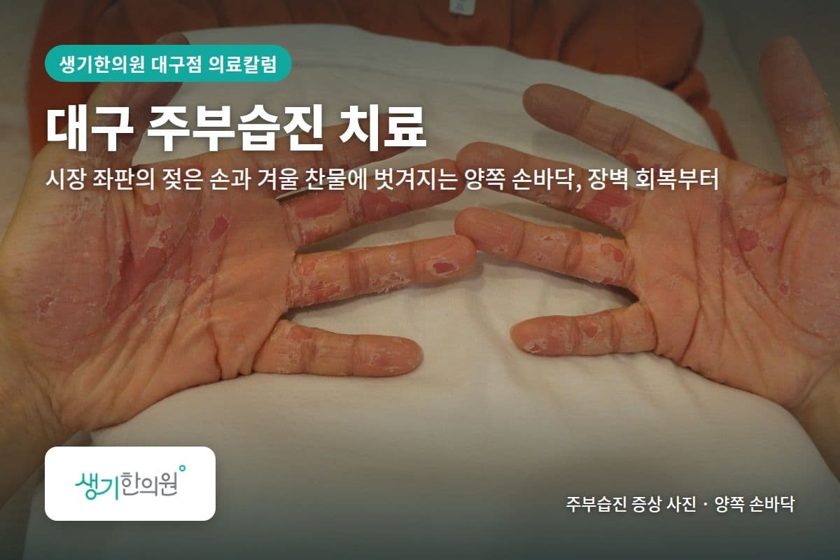 양쪽 손바닥 주부습진 증상 사진과 문구 「대구 주부습진 치료, 시장 좌판의 젖은 손과 겨울 찬물에 벗겨지는 양쪽 손바닥, 장벽 회복부터 · 생기한의원 대구점」