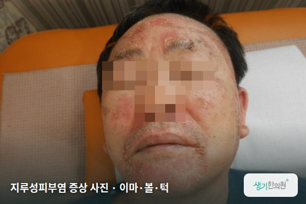 이마·볼·턱에 생긴 지루성피부염 증상 사진 — 지루성피부염 증상 사진 · 이마·볼·턱